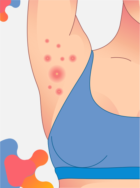 Conoce qué es la hidradenitis supurativa axilar con MedForum